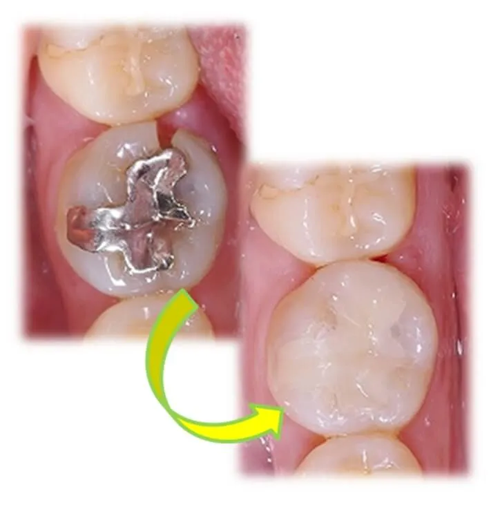 あらわい歯科では虫歯になりにくいCEREC(セレック)をオススメしています